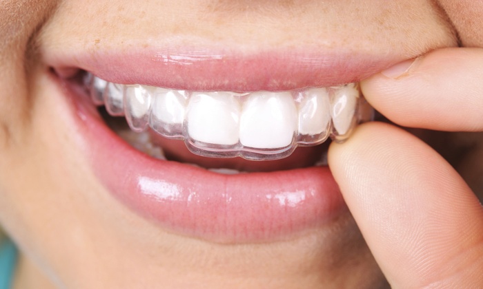 invisalign